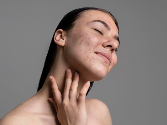 Anti-Aging Skincare Tutorial for Acne-Prone Skin